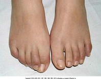 ankylosing spondylitis foot