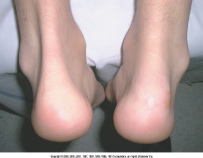 achilles tendinitis